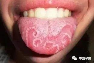 明星舌苔白,揭秘健康与饮食的微妙关系